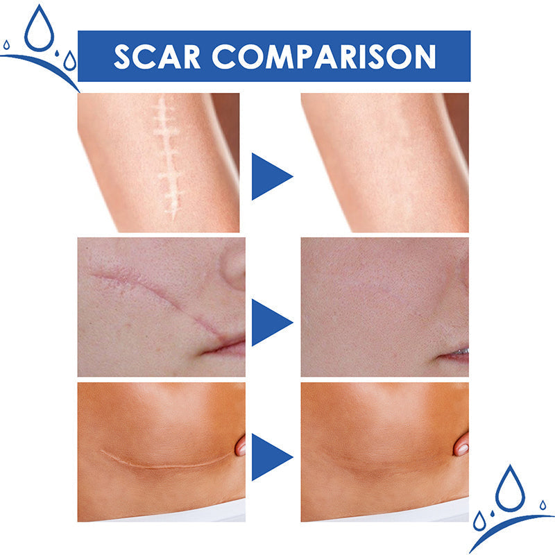 🔥𝑶𝒇𝒇𝒊𝒄𝒊𝒂𝒍 𝑺𝒕𝒐𝒓𝒆 | TIWORLD® Scar Removal Cream — Restore Skin & Regain Confidence🌹