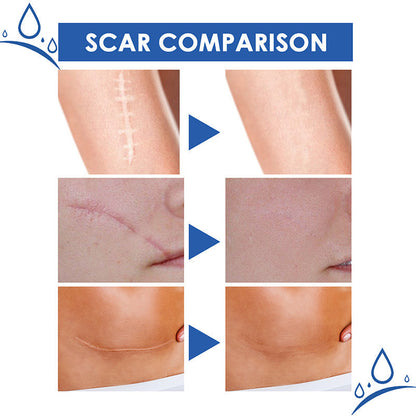 🔥𝑶𝒇𝒇𝒊𝒄𝒊𝒂𝒍 𝑺𝒕𝒐𝒓𝒆 | TIWORLD® Scar Removal Cream — Restore Skin & Regain Confidence🌹